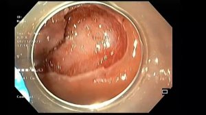 Удаление аденомы в прямой кишке способом ESD, 2021 11 06 16 58 21 Э 12564 ESD