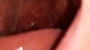 Tonsil Stone Removal With The Irrigator - Ep. 2 - Cutting The Cheese