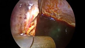 Лапароскпическая эхинококкэктомия печени