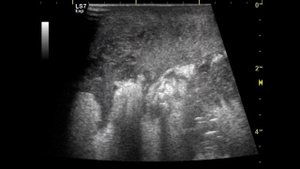 Гангрена Фурнье