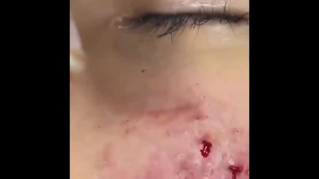 CRAZY Popping huge blackheads and Pimple Popping - BEST Pimple Popping COMPILATION #1