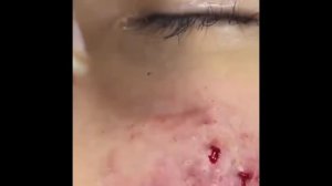 CRAZY Popping huge blackheads and Pimple Popping - BEST Pimple Popping COMPILATION #1