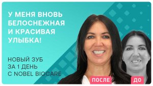 Как восстановить передний зуб за 1 день ? отзыв пациентки
