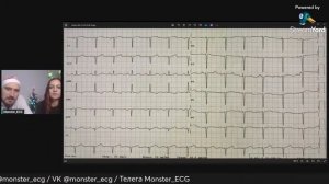 Разбор ЭКГ № 20 НОВОГОДНИЙ ВЫПУСК!