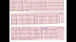 Важность записи ЭКГ на вдохе