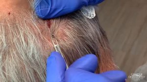 Blackheads Extraction From Behind the Head (Connect The Dots)