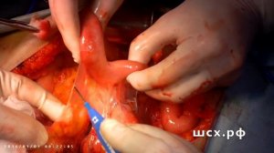 Работа коагулятора