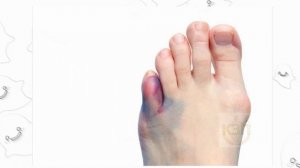 Как отличить перелом мизинца от ушиба на ноге? Как распознать перелом мизинца на ноге?