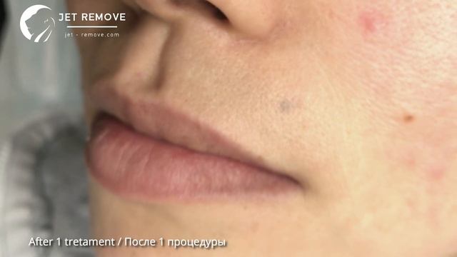 Удаление татуажа мушки (родинки, веснушки) ремувером Jet Remove. смотреть онлайн