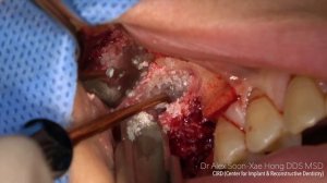 Maxillary sinus augmentation (two windows for the septum) & ridge augmentation GBR, Dr Alex Hong