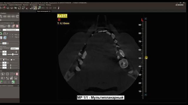 Программа NNTViewer iRYS Viewer  Компьютерная томограмма планирование имплантация зубов 3Д