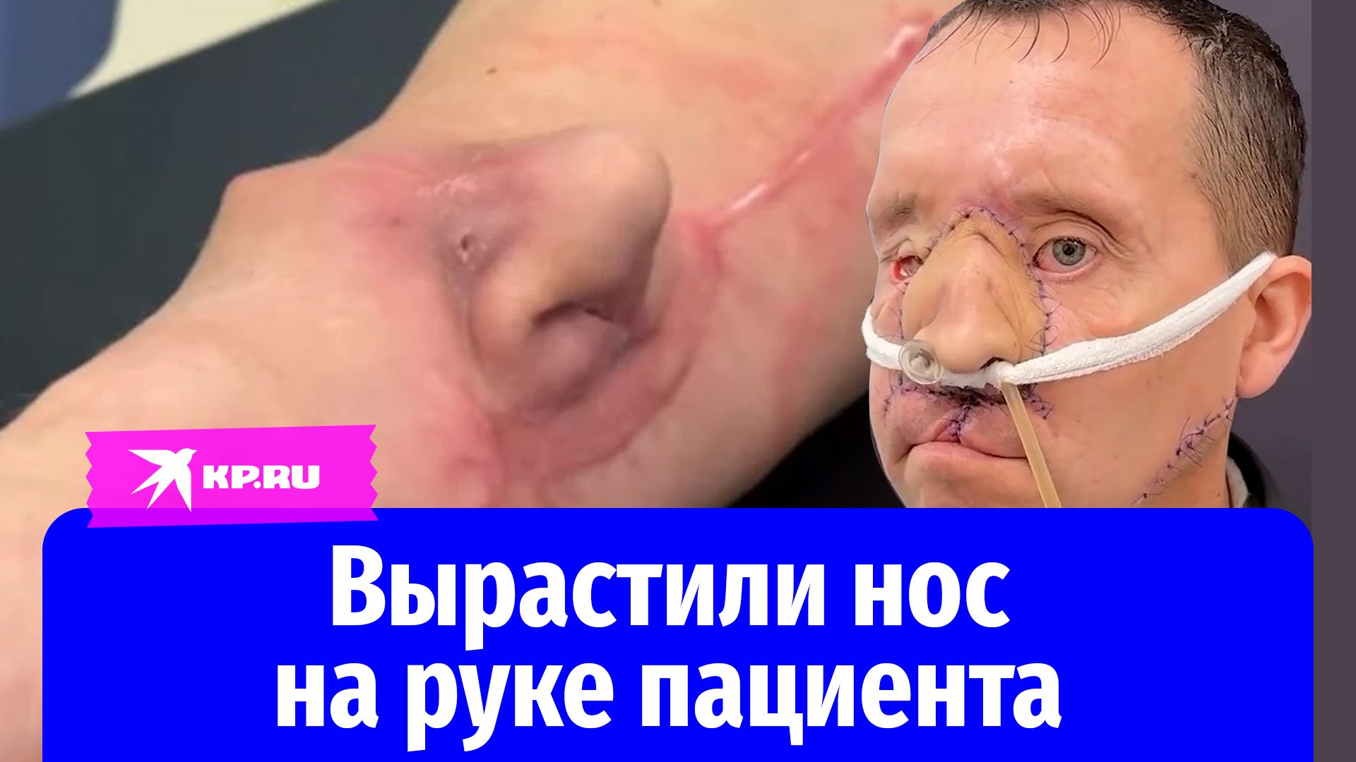 В Минске хирурги вырастили нос на руке пациента