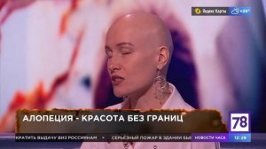 Мария Трухина. Личная история. Гнездная Алопеция.