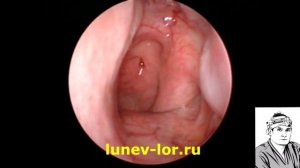 Синдром зияющией слуховой трубы 21022018