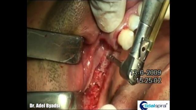 sinus lift הרמת סינוס