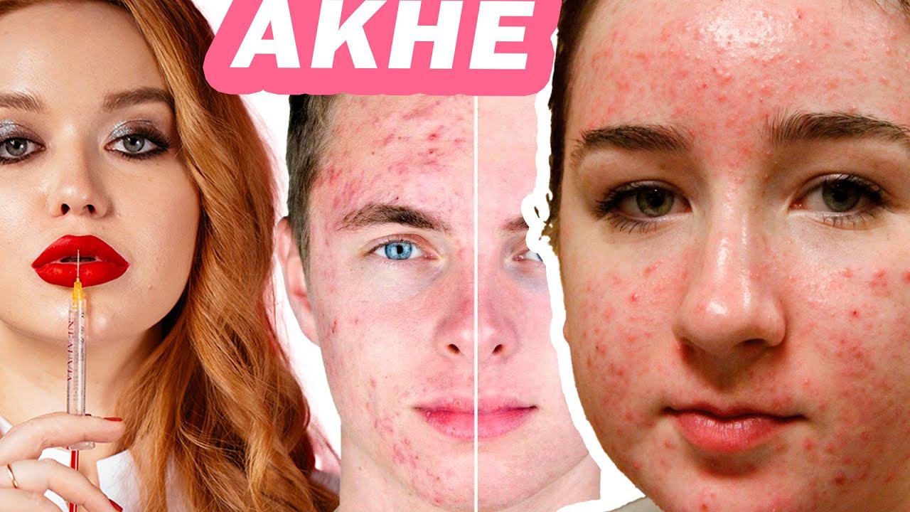 АКНЕ изучение проблемы! (Лекция 5-6 из марафона по лечению АКНЕ)