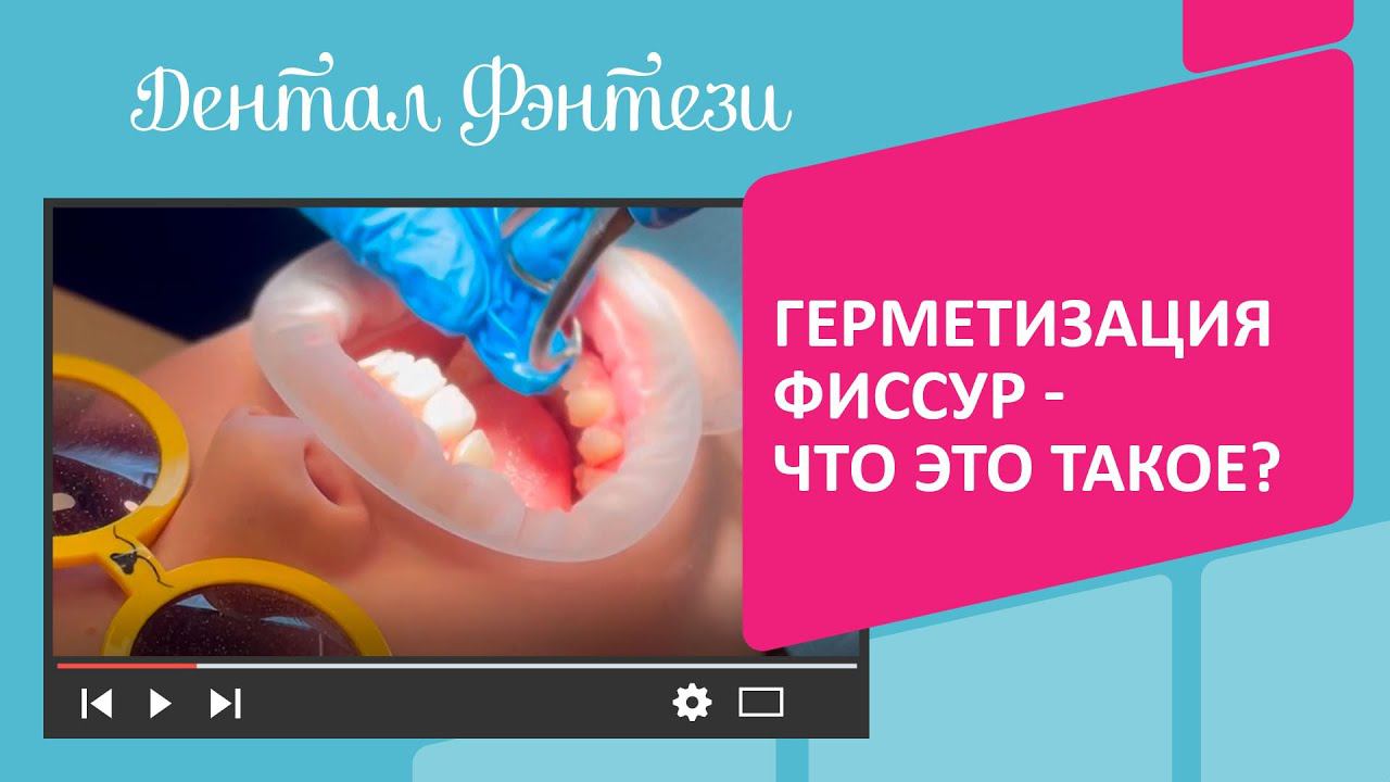 Герметизация фиссур - что это такое?