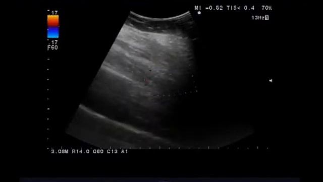 Методика сочетанного исследования артерий и вен нижних конечностей смотреть онлайн