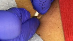 Dilated Pore of Winer