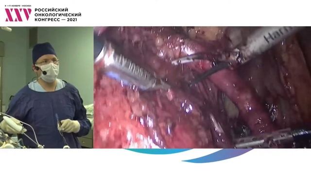 Хирургическая сессия: лапароскопическая гистерэктомия