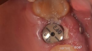 одномоментная имплантация