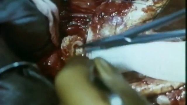 Хирургическое лечение аневризмы брюшной аорты 1979