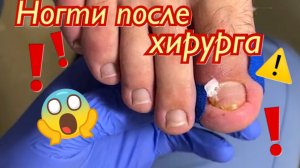 Ногти после хирурга ??❗️⚠️???