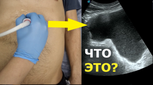 Киста поджелудочный железы или выпот?