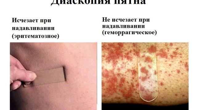 Морфологические элементы сыпи