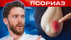 Как избавиться от ПСОРИАЗА НАВСЕГДА? Это все что тебе нужно знать!