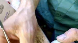 Приварка зуба на бюгельный протез часть 2