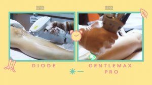 Diode vs. Gentlemax Pro laser hair removal by Wink Laser Studio