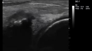 Повреждение заднего рога медиального мениска