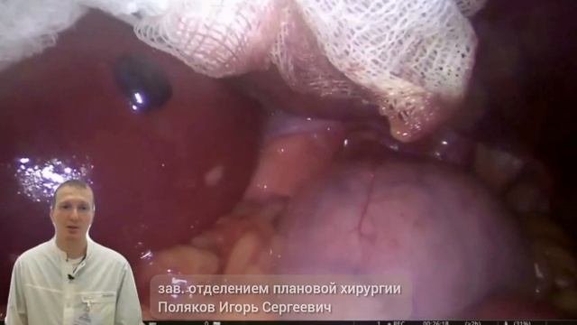 Грыжи пищеводного отверстия диафрагмы – это одна из самых часто встречающихся патологий