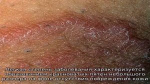 Все о паховом дерматите