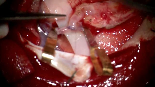 ЭИКМА (экстраинтракраниальный микроанастомоз) смотреть онлайн