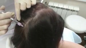 Лечение волос филлер-биоревитализанта Hair Filler.