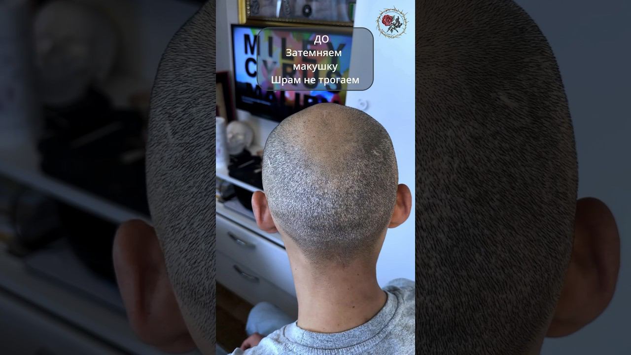 Затемнение макушки без шрама после пересадки волос. Трихопигментация Smp Scalp micropigmentation
