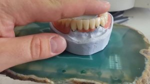 Съёмный протез на телескопических коронках