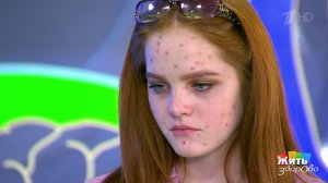 Прыщам - бой! Жить здорово! Фрагмент выпуска от 26.04.2018