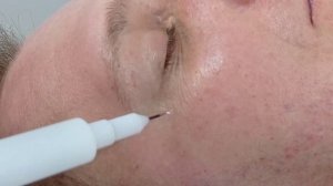 Холодная плазма. Шлифовка морщин.