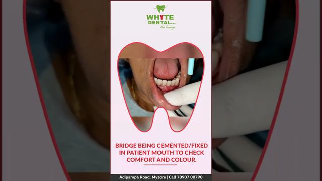 All ceramic bridge looks and feels like a natural tooth.