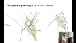 Переломы проксимального отдела большеберцовой кости