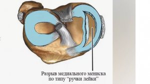 Ручка лейки,17 день после операции