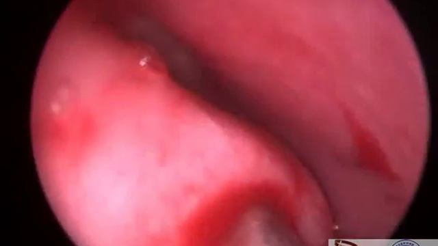 Микрогайморотомия с нижней щадящей конхотомией.