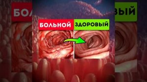 Синдром ДЫРЯВЫЙ КИШЕЧНИК О. А. Бутакова