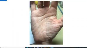 Линия брака, разрыв, наклон вниз, входит в линию сердца. Расставание, разочарование/Хиромантия