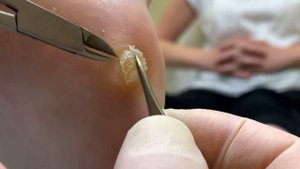 Вырезаю глубокую мозоль за пару минут