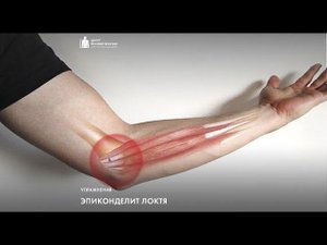 "локоть теннисиста" или эпикондилит. Комплекс упражнений для лечения