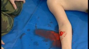 Виды кровотечений